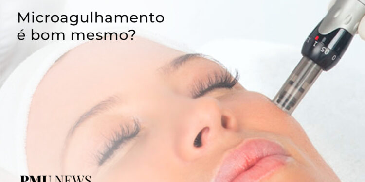 microagulhamento-vale-a-pena