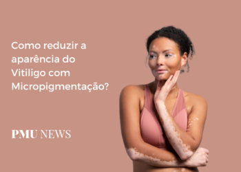 Micropigmentação: Uma Solução para Camuflar Manchas de Vitiligo