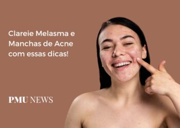6 segredos para clarear Melasma e Manchas de Acne