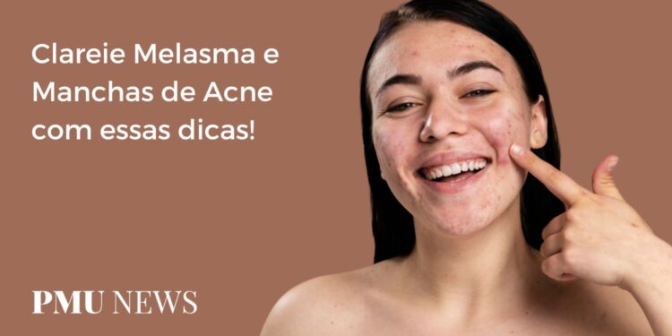 6 segredos para clarear Melasma e Manchas de Acne