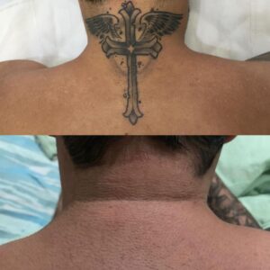 remoçao de tatuagem