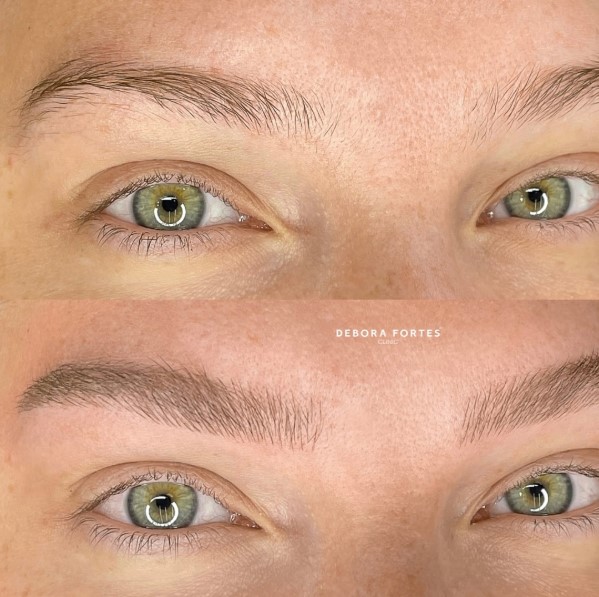 fio a fio no dermografo antes e depois exemplo - 8