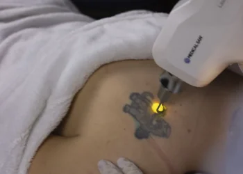 Conheça o Laser Ômer Smart