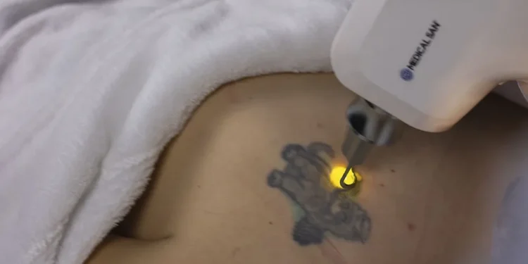 Conheça o Laser Ômer Smart